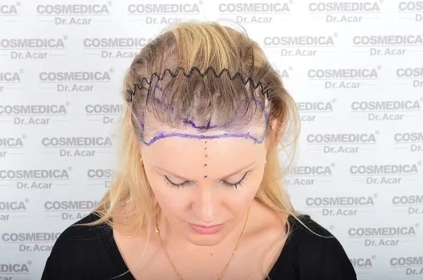 Hair transplant for women result from Cosmedica clinic