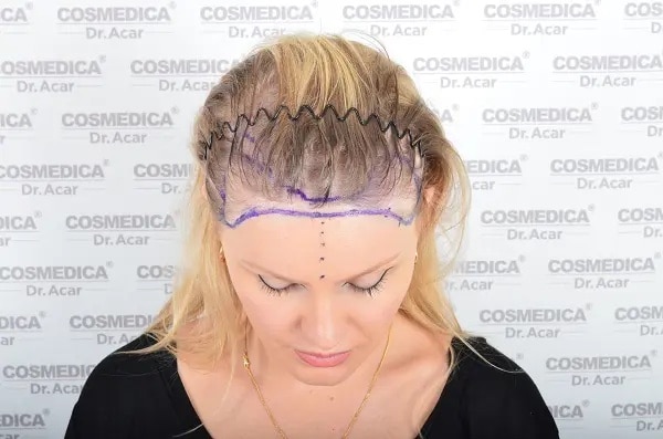 Hair Transplant for Women  Cosmedica  Dr Levent Acar