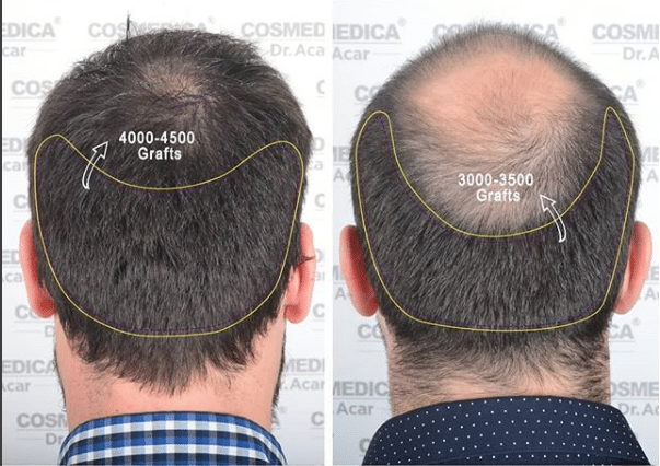 Мужчина до и после пересадки волос