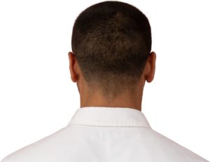 Hair transplant donor area of a man