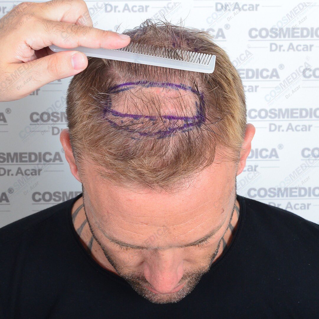 Dr. Acar pettina all'indietro i capelli di Calum Best per mostrare la caduta dei capelli nella parte superiore