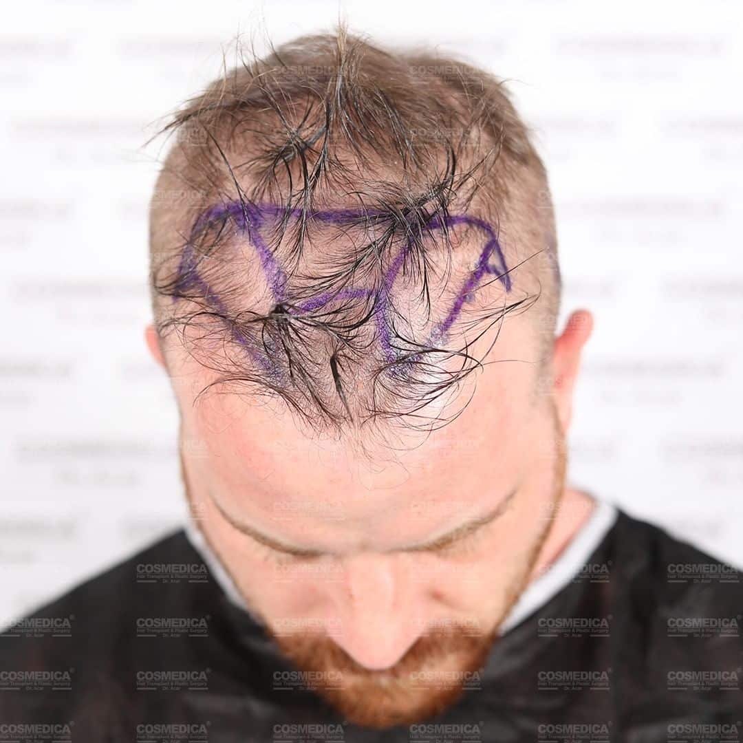 Caduta dei capelli di Rob Kazinsky