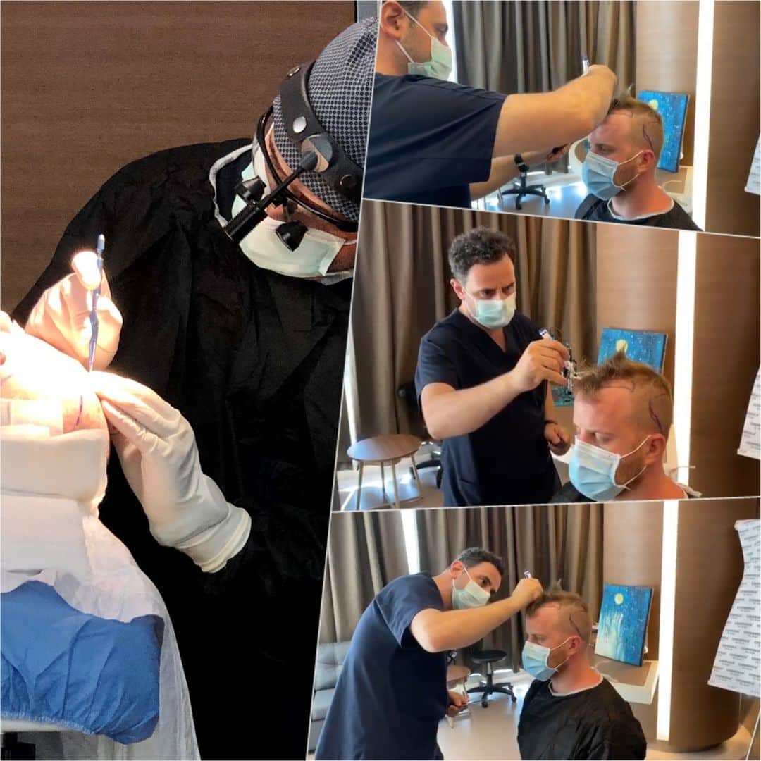 Collage di foto di Rob Kazinsky durante il consulto con il Dr. Acar e durante il trapianto di capelli