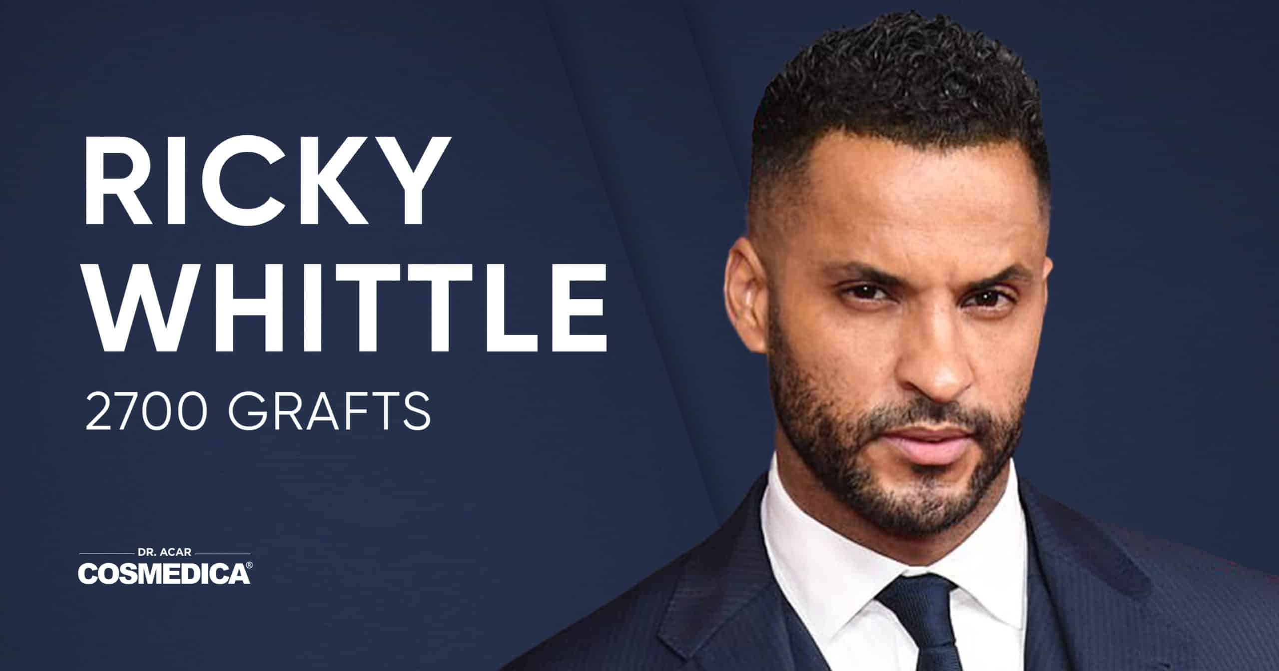 Hair Transplant of British Actor Ricky Whittle