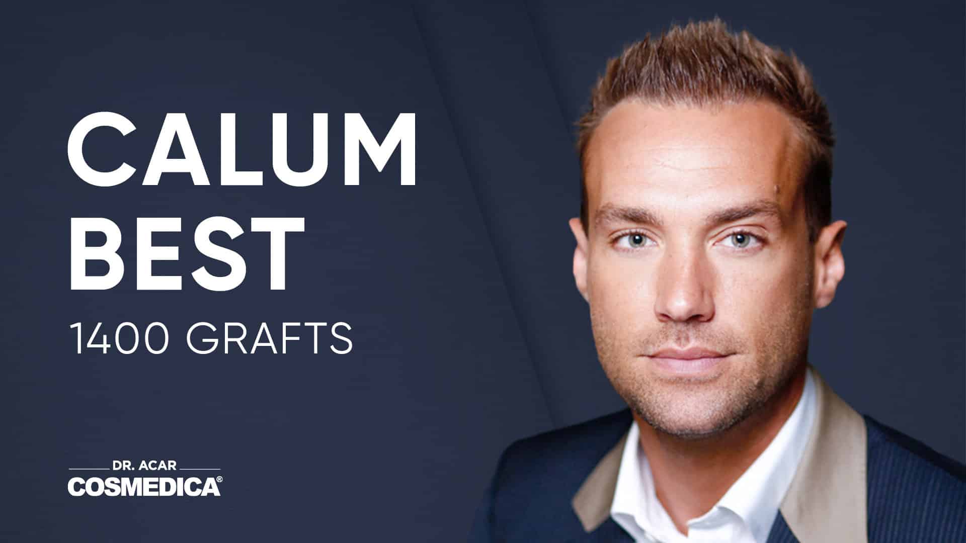 Calum Best did visit Cosmedica Clinic - Dr. Acar to have his hair transplant done in Turkey.