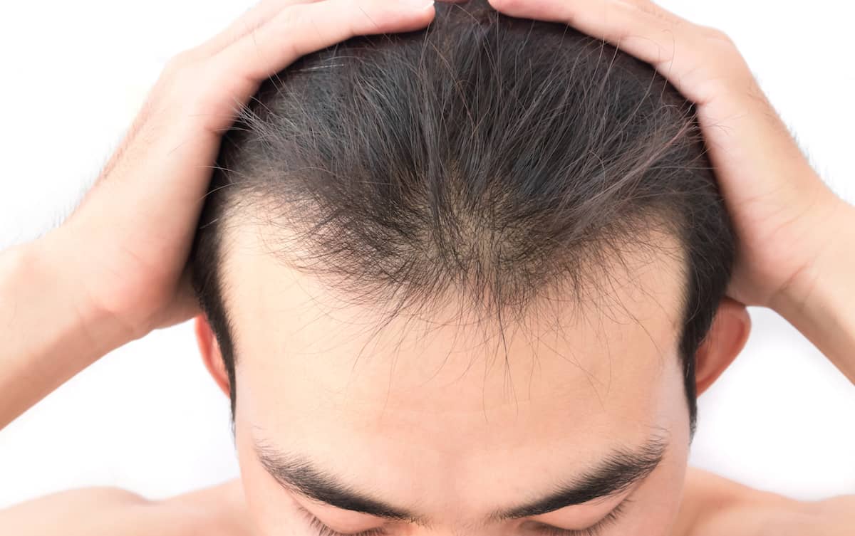 Man with low density first hair transplant results, a suitable candidate for a second hair transplant