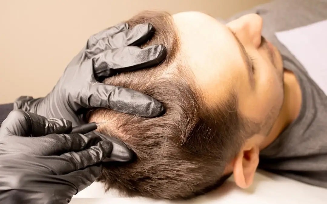 Man getting scalp micropigmentation after hair transplant