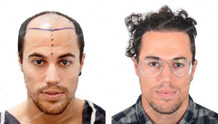 Zdjęcie mężczyzny przed i po przeszczepie włosów