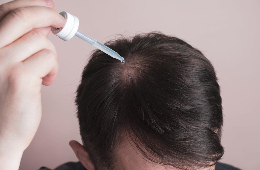 Homme appliquant du minoxidil pour lutter contre la chute de cheveux au moyen d'un compte-gouttes