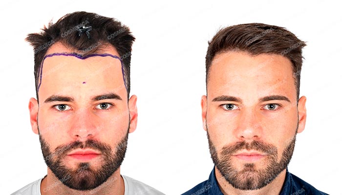 Mężczyzna przed i po przeszczepie włosów