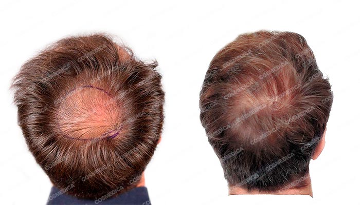 Mężczyzna przed i po przeszczepie włosów