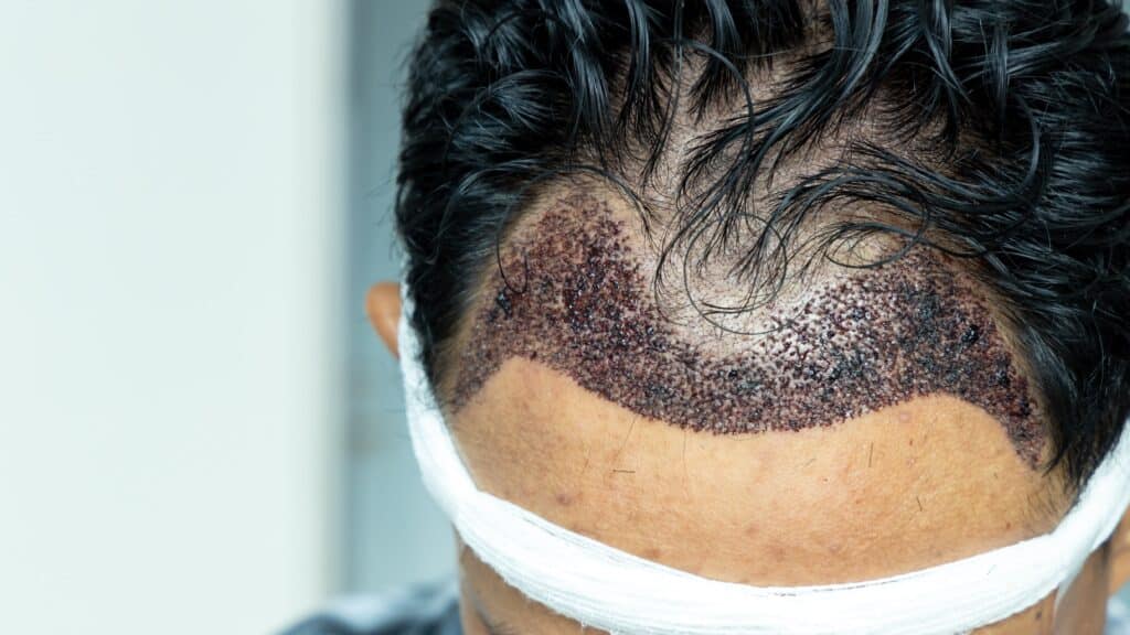 Man head after a hair transplant surgery.