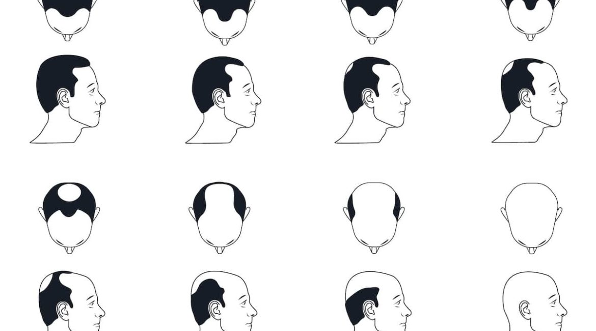 Norwood scale Infographic