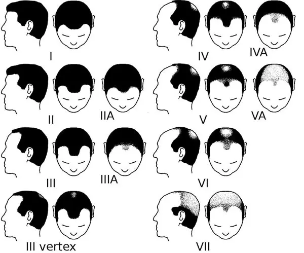 Норвудская шкала стадии выпадения волос у мужчин
