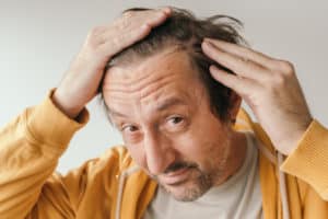 Мужчина с фронтальной фиброзной алопецией смотрит в зеркало, озабоченный потерей волос на лбу