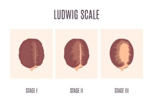 Picture showing the different stages of the Ludwig scale