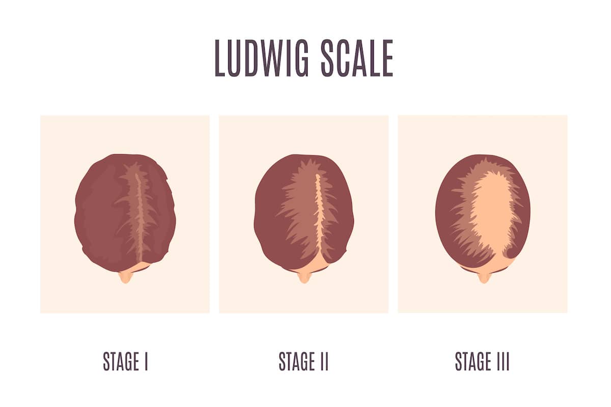 Ludwig scale | Types of hair loss – Neofollics