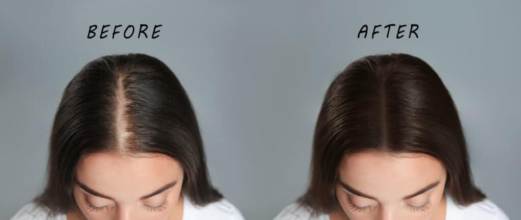 Donna con problema di perdita di capelli prima e dopo il trattamento di trapianto capelli
