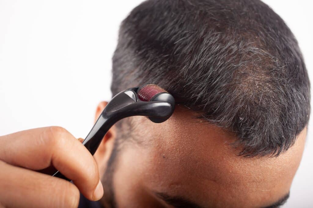 Homme utilisant un Dermaroller pour prévenir la chute de ses cheveux