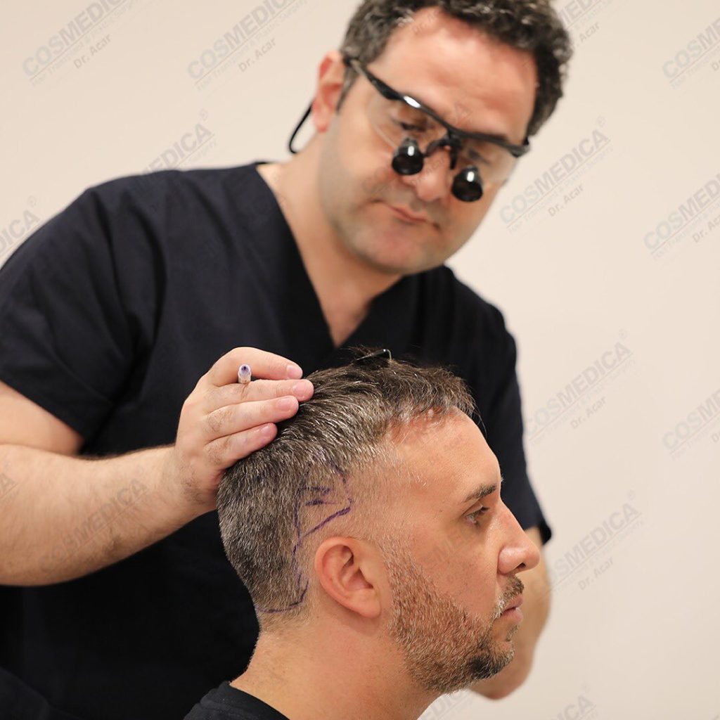 Dr. Acar analysing Keiran Lee's hairline before the hair transplant procedure