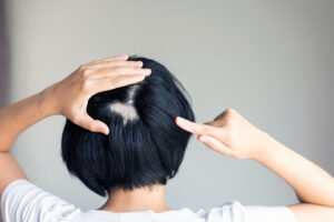 Donna con alopecia areata dietro la nuca