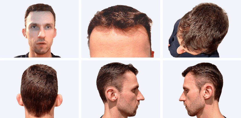 Fryzura pacjenta Dawida w różnych ujęciach 12 miesięcy po przeszczepie włosów