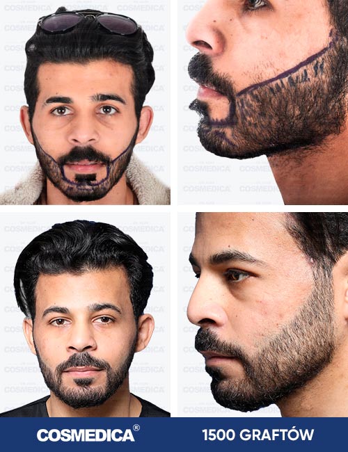 Mężczyzna przed i po 1500 przeszczepach brody