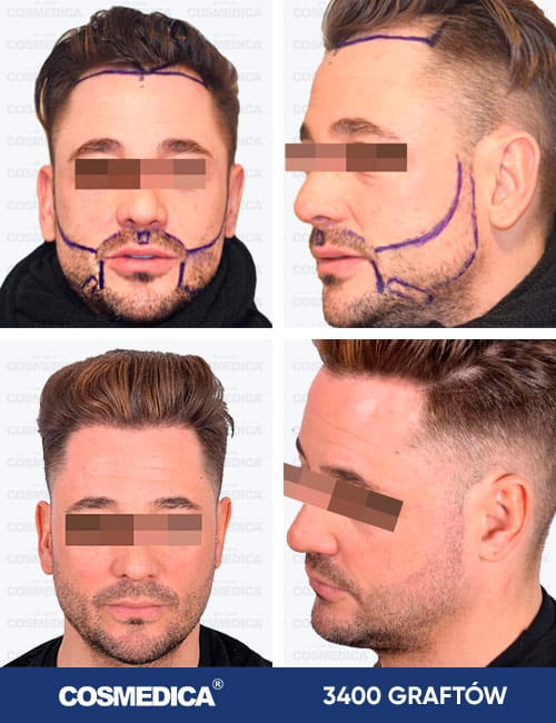 Mężczyzna przed i po przeszczepie brody na 3400 przeszczepach