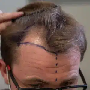 Мужчина при подготовке к проведению пересадки волос