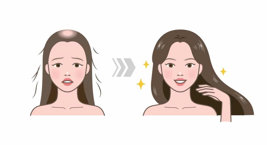 Disegno che mostra i capelli di una donna prima e dopo il trattamento di trapianto capelli dall'aspetto naturale
