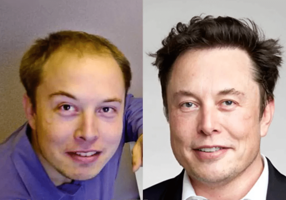 Elon Musk voor en na zijn haartransplantatie