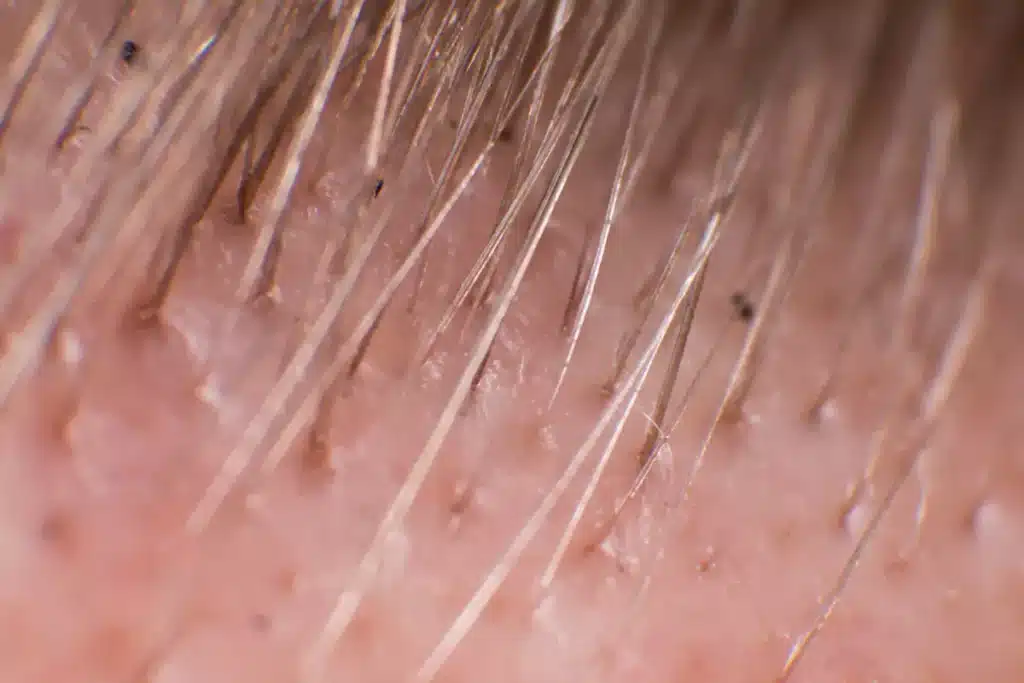 Close up of a male hair line with follicular units visible