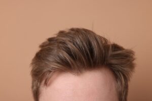 Trapianto Capelli Naturali: I capelli di un uomo dall’aspetto naturale dopo un trapianto di capelli