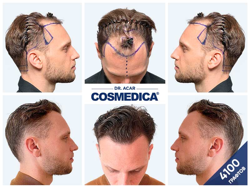 Мужчина с пересаженными волосами фото до и после