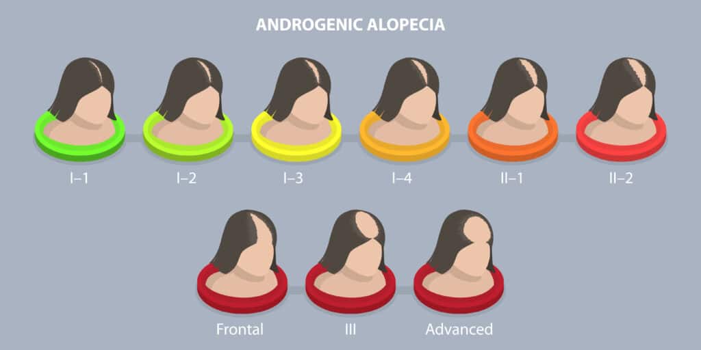 Illustrazione concettuale dell'alopecia androgenetica, progressione della calvizie