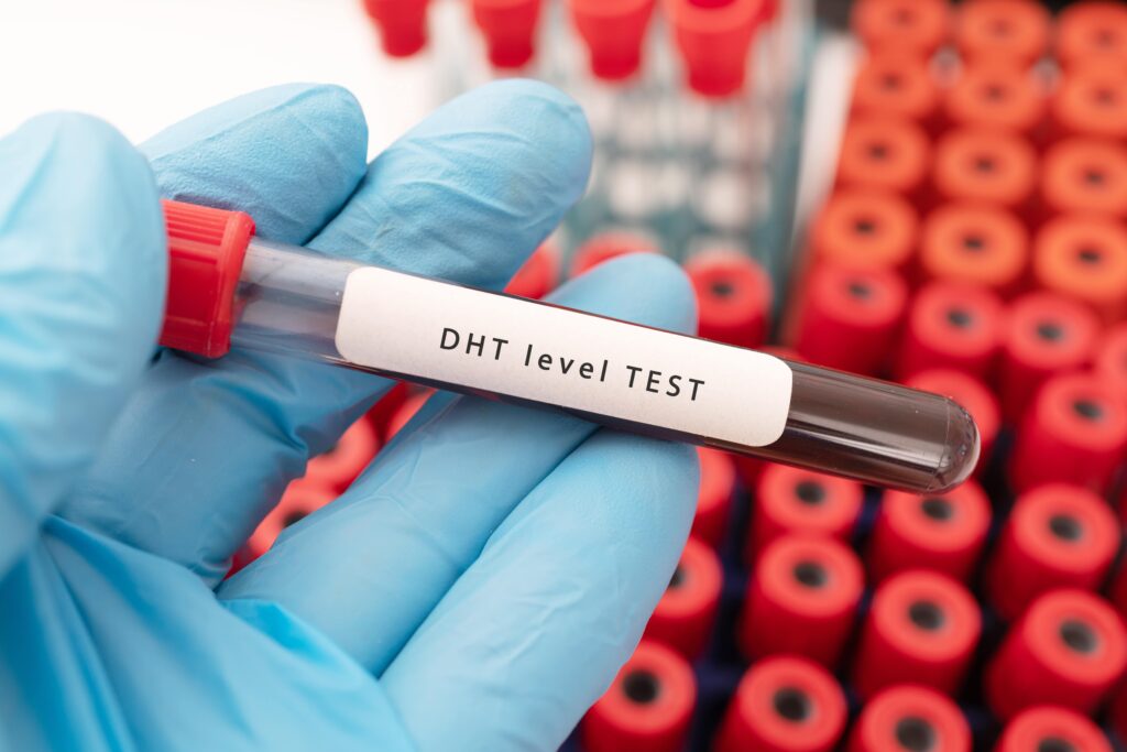 Main tenant une éprouvette contenant le sang d'un patient pour l'analyse de la dihydrotestostérone (DHT).