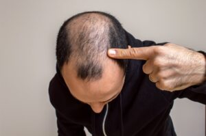 Un jeune homme montre sa perte de cheveux