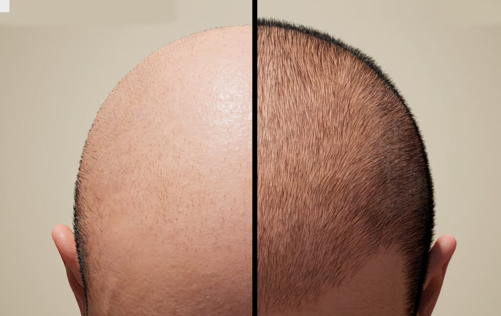 Before-after result of a hair transplant in Turkey