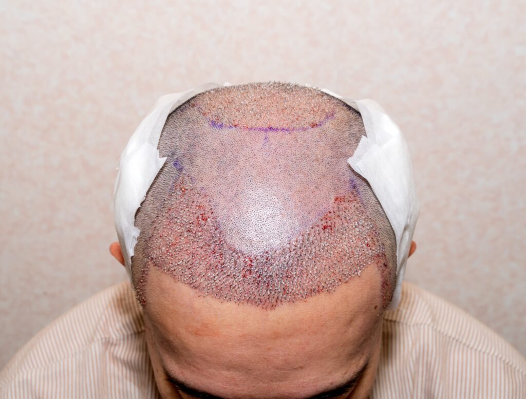 Top view of a man's head with hair transplant surgery