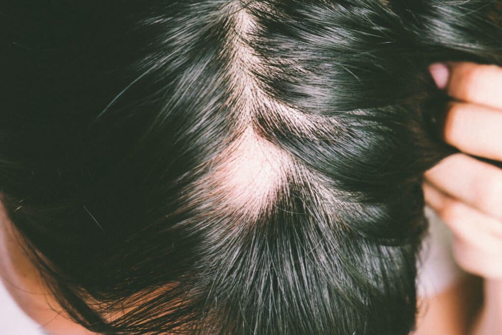 Woman with scarring alopecia