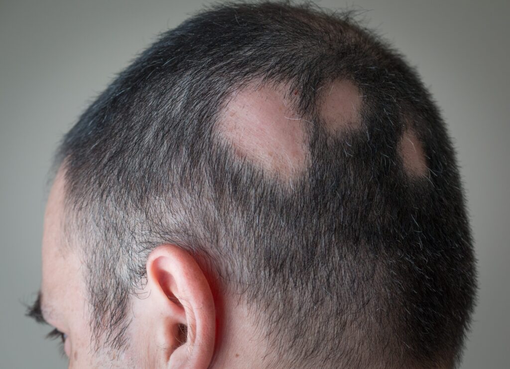 Man with spot baldness hair loss