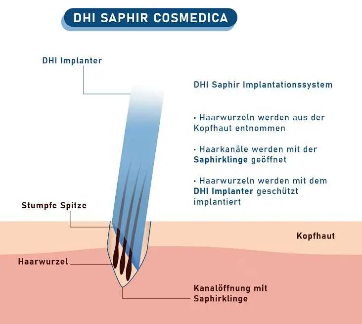 DHI Saphir ImplSystem