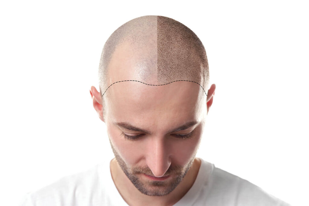 Vor der Haartransplantation