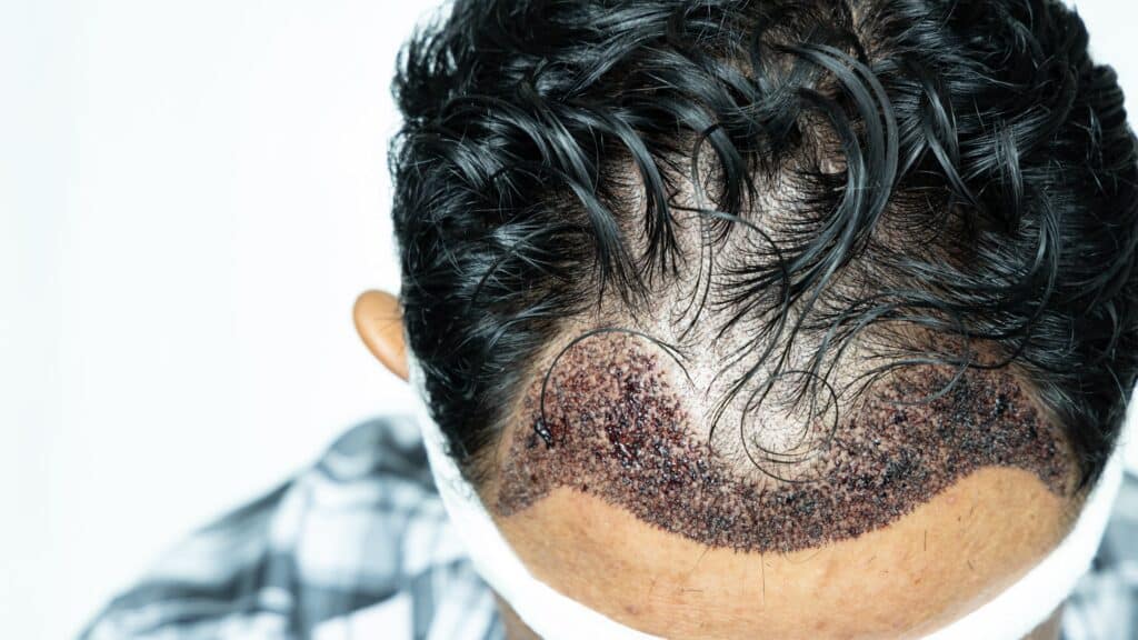 Scalp of a man right after a hair transplant