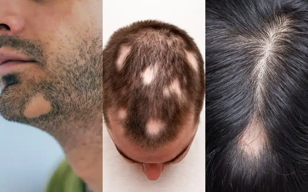 Alopecia-Areata