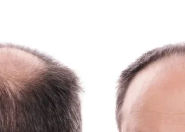 Finasterid gegen Haarausfall: Wirkung, Nebenwirkungen, Risiken & Alternativen