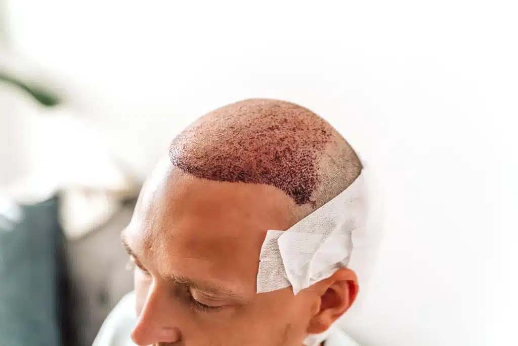 Nach-der-zweiten-Haartransplantation