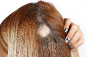 alopecia areata feminina