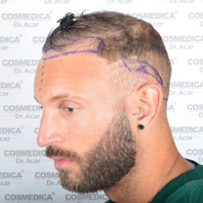 Liam McAleese Haarausfall linke Seite
