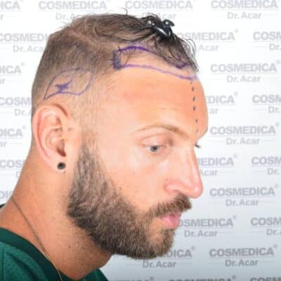 Liam McAleese Haarausfall rechte Seite